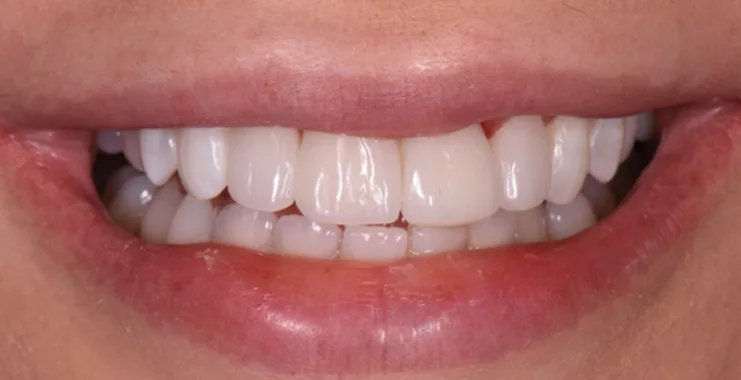 Smile na de behandeling met facings composiet